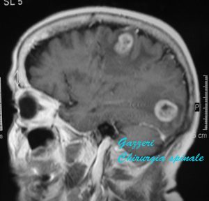 metastasi cerebrali